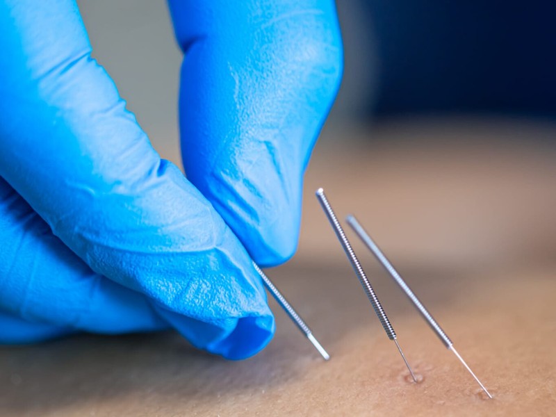 dry needling